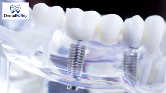 When Are Spiral Implants The Best Choice for Surgeons?