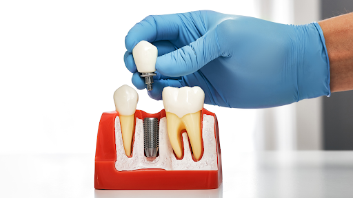 The Ultimate Guide to Choose the Right Dental Implants for Your Patients