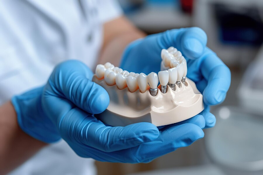 A Comprehensive Guide to Successfully Integrating Dental Implants into Your Practice