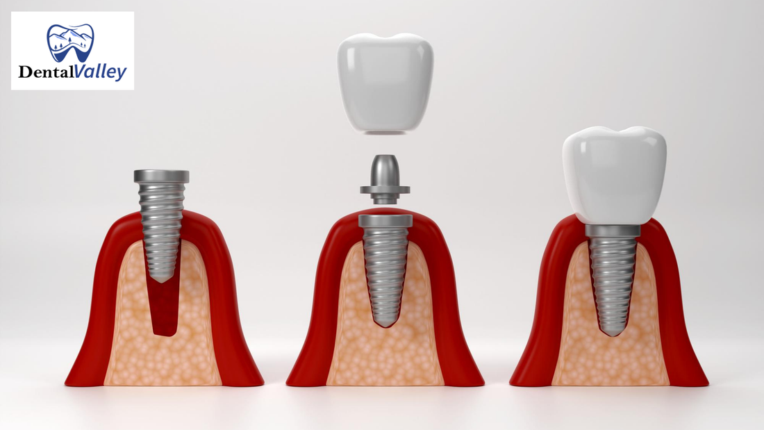 Proven Sinus Stopper Implants For Limited Bone Height Cases