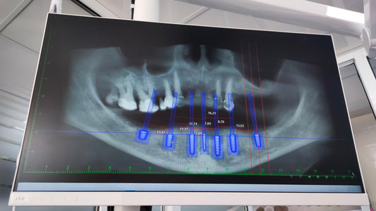 Dental Implant Failure: Causes, Early Signs and Prevention | Dental Valley