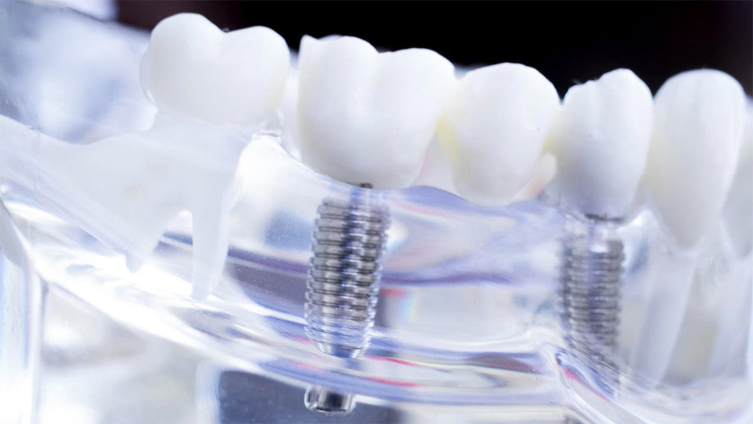 When Are Spiral Implants The Best Choice for Surgeons?